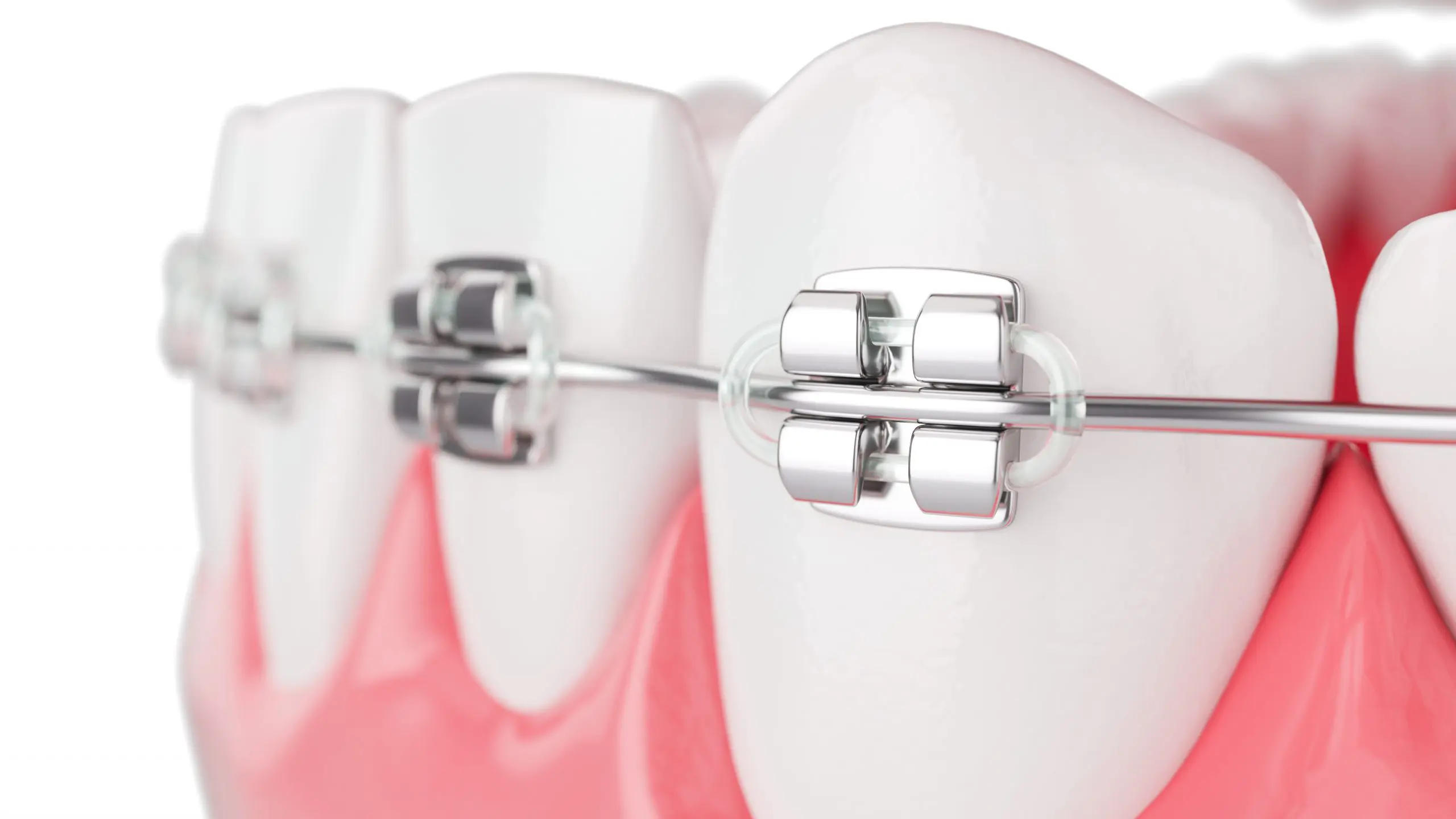 https://harmonymedical.sa/wp-content/uploads/2024/10/close-up-beauty-health-teeth-with-brace-selective-focus-3d-render-scaled-1.webp