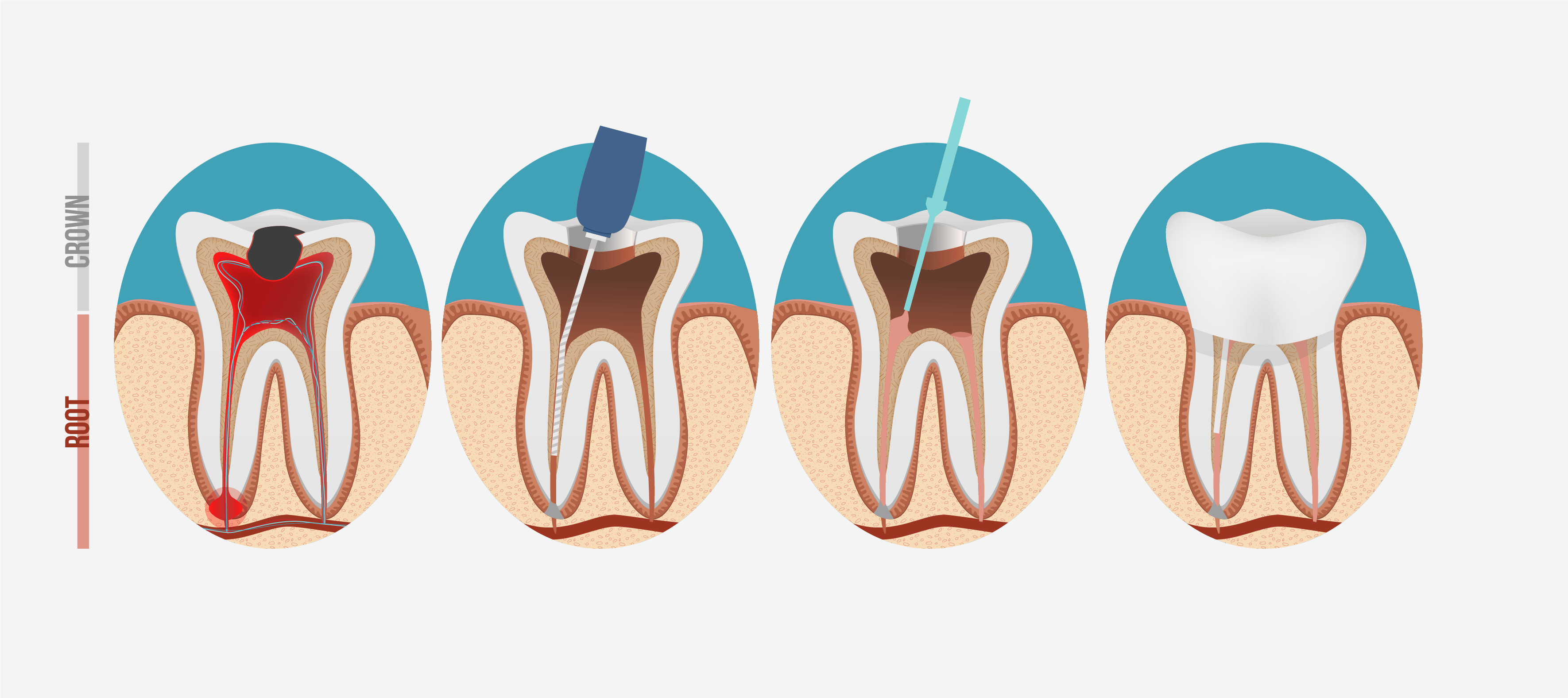 https://harmonymedical.sa/wp-content/uploads/2024/11/root-canal-process.png